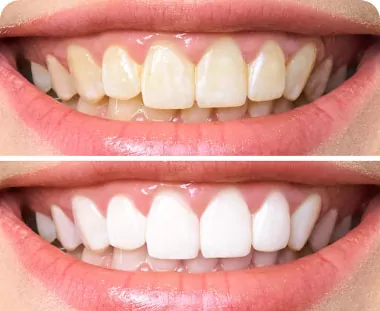 Teeth Whitening Annandale
